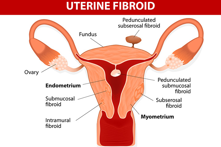 Uterine Fibroids Treatment in Greater Noida